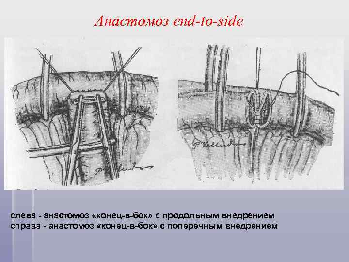 Анастомоз end-to-side слева - анастомоз «конец-в-бок» с продольным внедрением справа - анастомоз «конец-в-бок» с