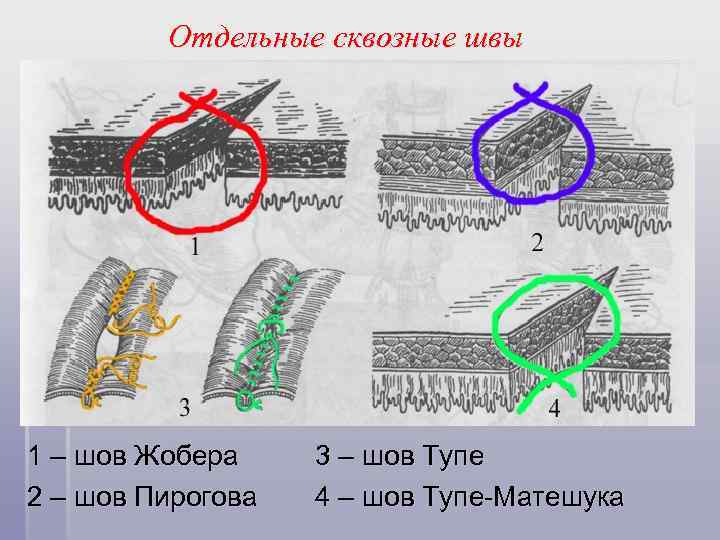 Отдельные сквозные швы 1 – шов Жобера 2 – шов Пирогова 3 – шов