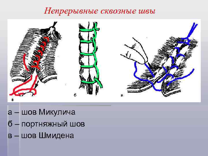 Непрерывные сквозные швы а – шов Микулича б – портняжный шов в – шов