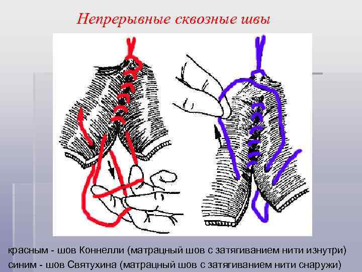 Непрерывные сквозные швы красным - шов Коннелли (матрацный шов с затягиванием нити изнутри) синим