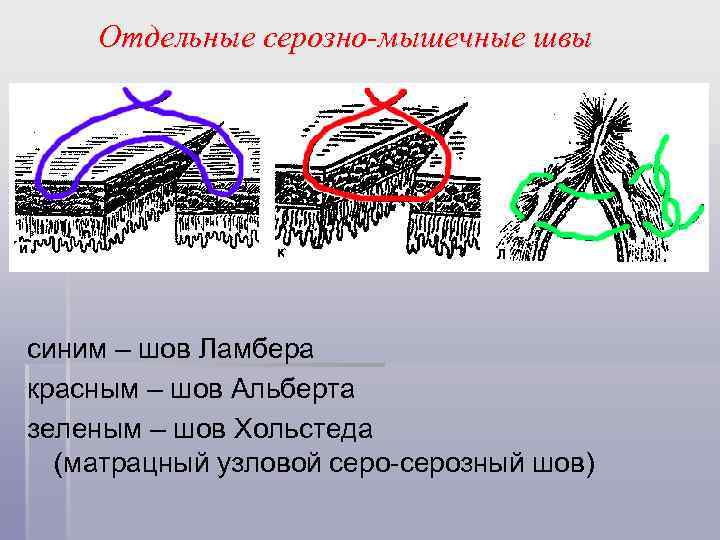 Отдельные серозно-мышечные швы синим – шов Ламбера красным – шов Альберта зеленым – шов