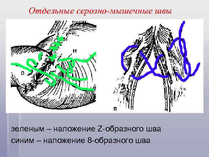 Отдельные серозно-мышечные швы зеленым – наложение Z-образного шва синим – наложение 8 -образного шва