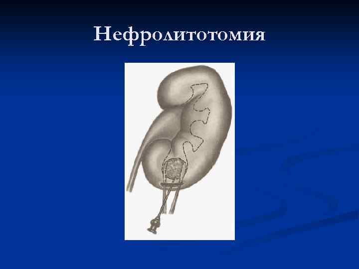 Нефролитотомия 