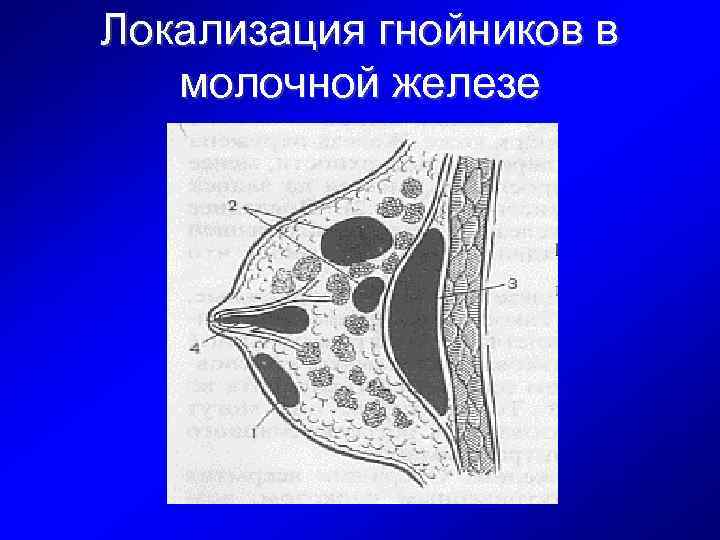 Локализация гнойников в молочной железе 