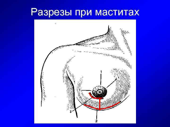 Разрезы при маститах 