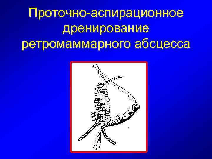 Проточно-аспирационное дренирование ретромаммарного абсцесса 