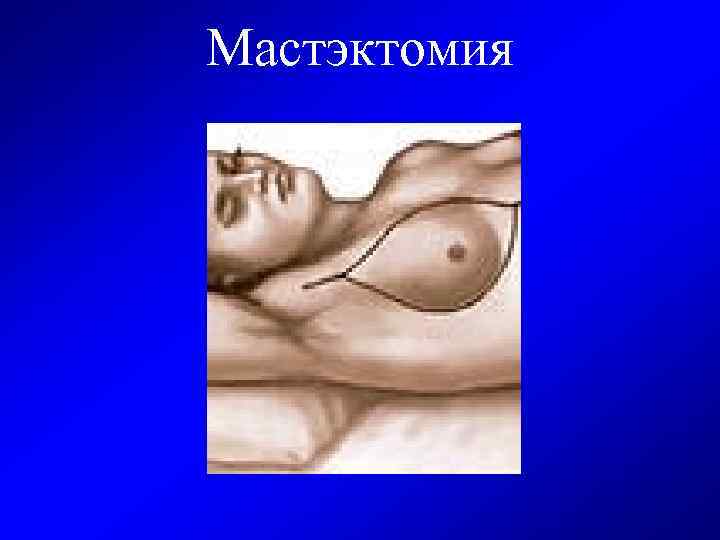 Мастэктомия 