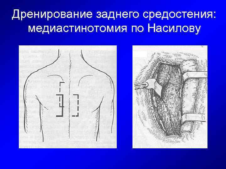 Дренирование заднего средостения: медиастинотомия по Насилову 
