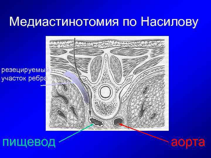 Медиастинотомия по Насилову резецируемый участок ребра пищевод аорта 