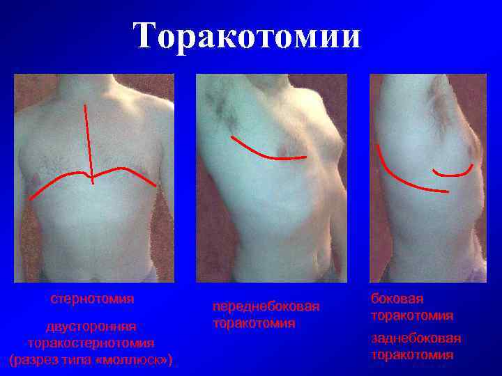 Торакотомии стернотомия двусторонняя торакостернотомия (разрез типа «моллюск» ) переднебоковая торакотомия заднебоковая торакотомия 