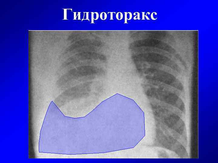 Гидроторакс 
