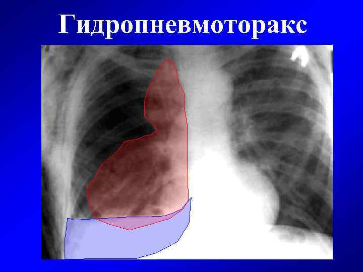 Синдром передней грудной стенки