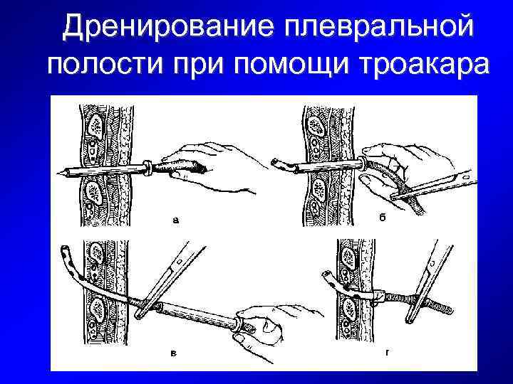 Дренирование плевральной полости при помощи троакара 
