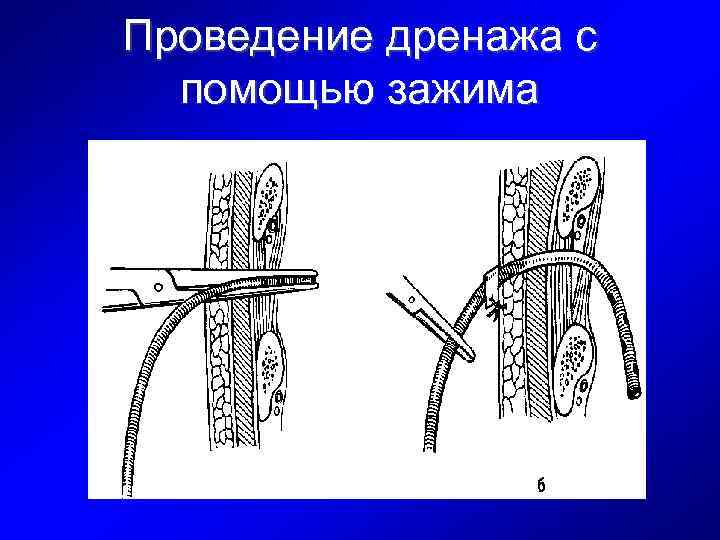 Проведение дренажа с помощью зажима 