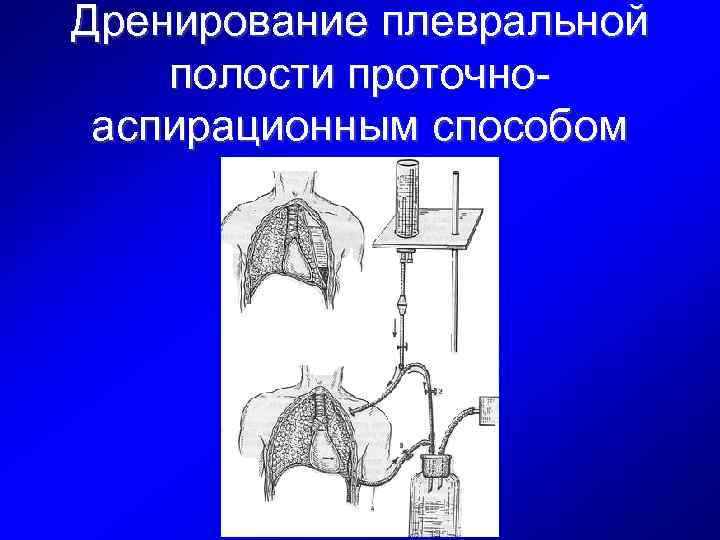 Дренирование плевральной полости проточноаспирационным способом 