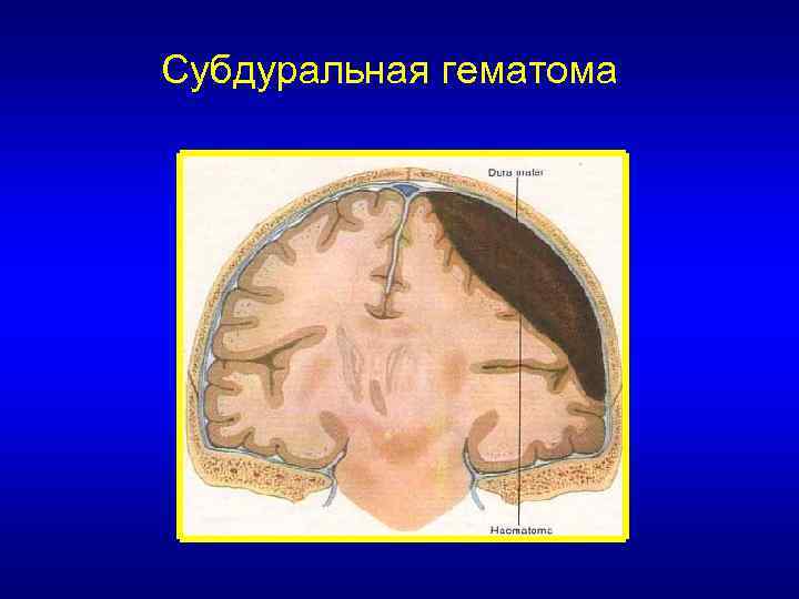 Субдуральная гематома 