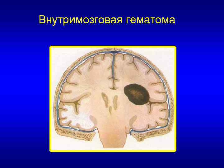 Внутримозговая гематома 