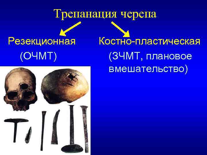 Трепанация черепа Резекционная (ОЧМТ) Костно-пластическая (ЗЧМТ, плановое вмешательство) 