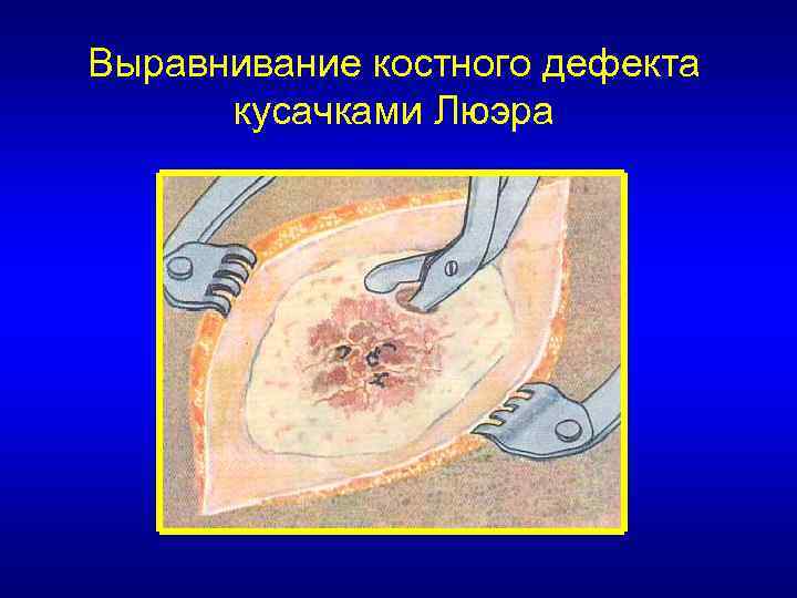 Выравнивание костного дефекта кусачками Люэра 