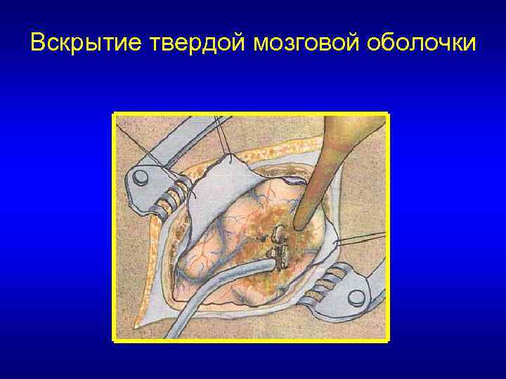 Вскрытие твердой мозговой оболочки 