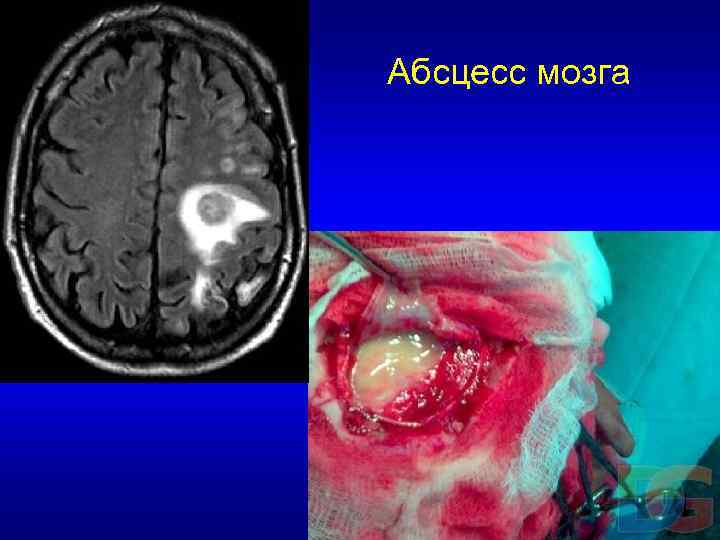 Абсцесс мозга 
