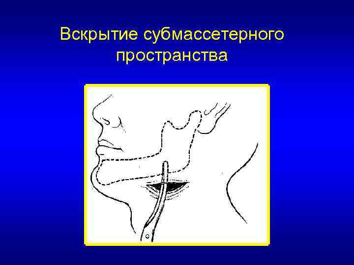 Вскрытие субмассетерного пространства 