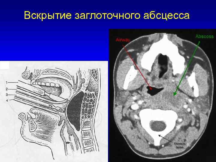 Вскрытие флегмон и абсцессов. Внутриминдаликовый абсцесс. Паратензиальный абсцесс. Перитонзиллярный абсцесс. Заглоточный абсцесс кт.