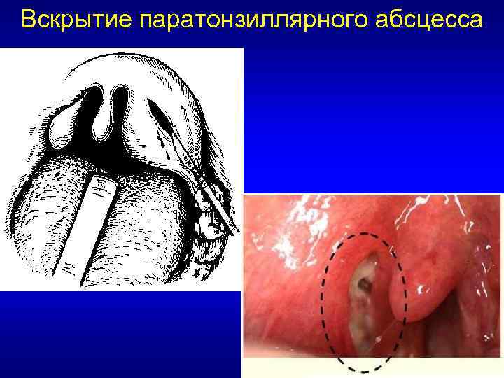 Вскрытие паратонзиллярного абсцесса 