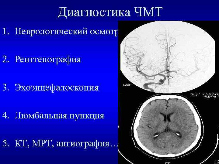 Диагностика ЧМТ 1. Неврологический осмотр 2. Рентгенография 3. Эхоэнцефалоскопия 4. Люмбальная пункция 5. КТ,