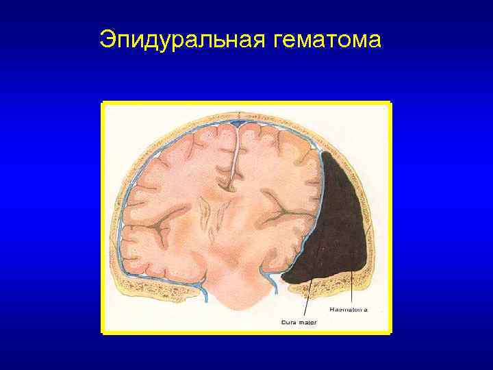 Эпидуральная гематома 