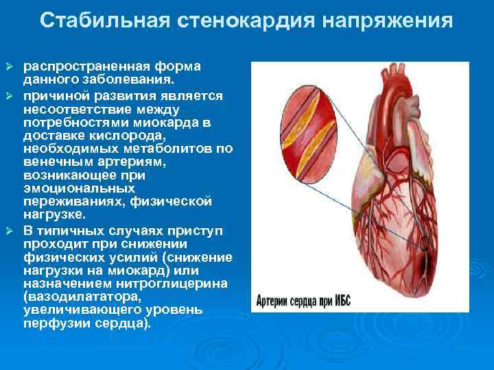 Стабильная стенокардия напряжения распространенная форма данного заболевания. Ø причиной развития является несоответствие между потребностями