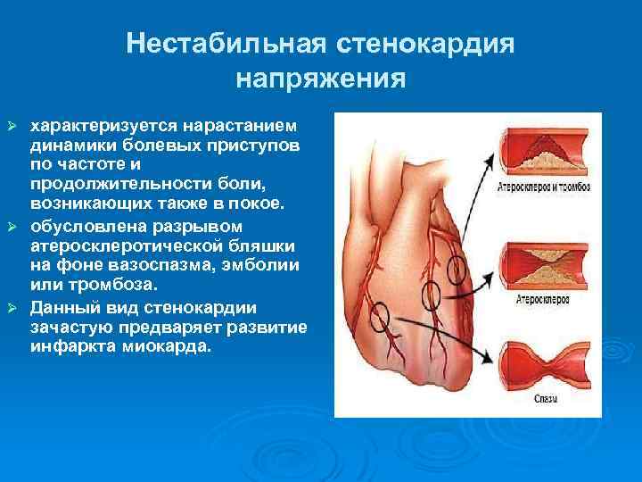 Нестабильная стенокардия напряжения характеризуется нарастанием динамики болевых приступов по частоте и продолжительности боли, возникающих