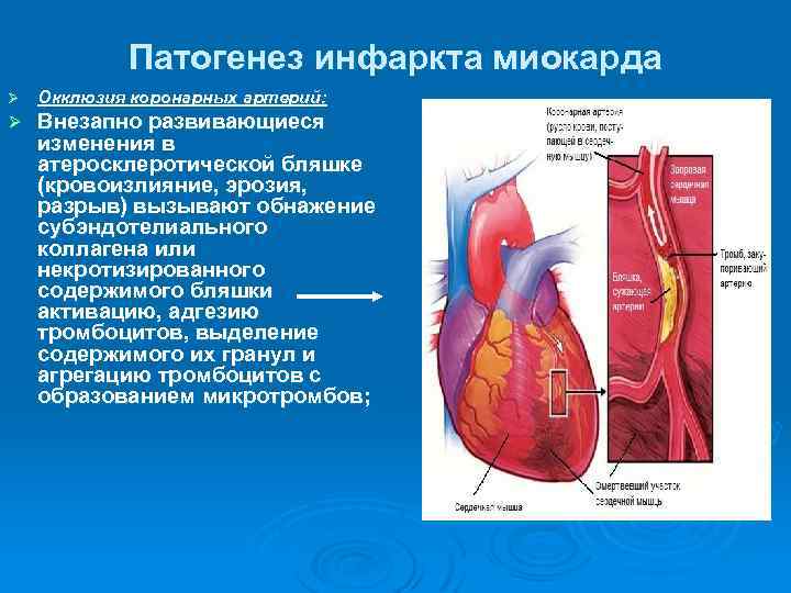Патогенез инфаркта миокарда Ø Окклюзия коронарных артерий: Ø Внезапно развивающиеся изменения в атеросклеротической бляшке