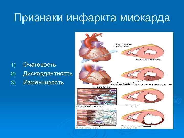 Признаки инфаркта миокарда 1) 2) 3) Очаговость Дискордантность Изменчивость 