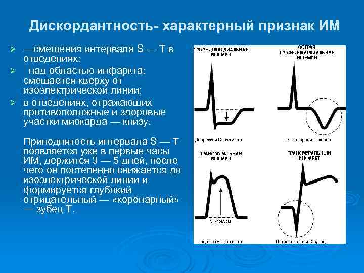 Дискордантность- характерный признак ИМ —смещения интервала S — T в отведениях: Ø над областью