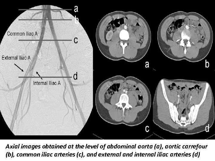 Axial images obtained at the level of abdominal aorta (a), aortic carrefour (b), common