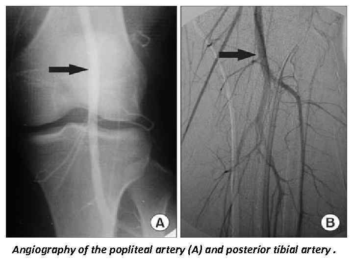 Angiography of the popliteal artery (A) and posterior tibial artery. 