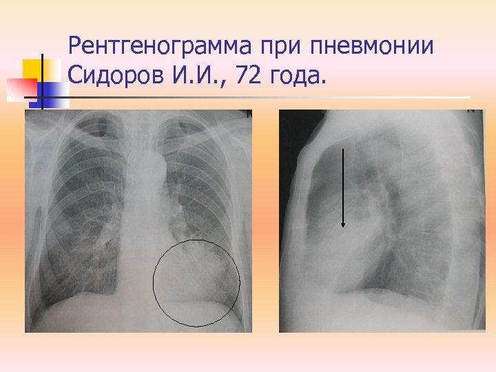 Рентгенограмма при пневмонии Сидоров И. И. , 72 года. 