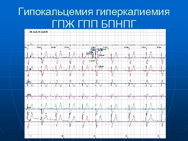 Гипокальцемия гиперкалиемия ГПЖ ГПП БПНПГ 