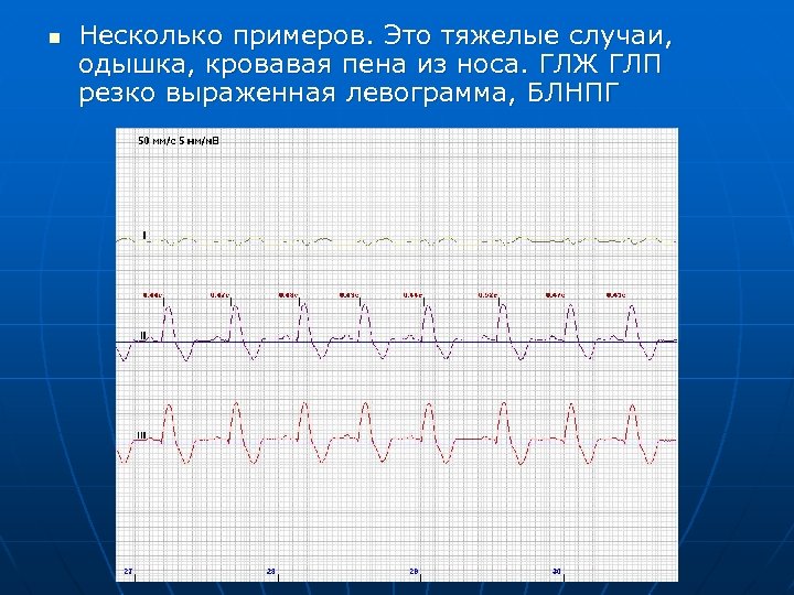 n Несколько примеров. Это тяжелые случаи, одышка, кровавая пена из носа. ГЛЖ ГЛП резко