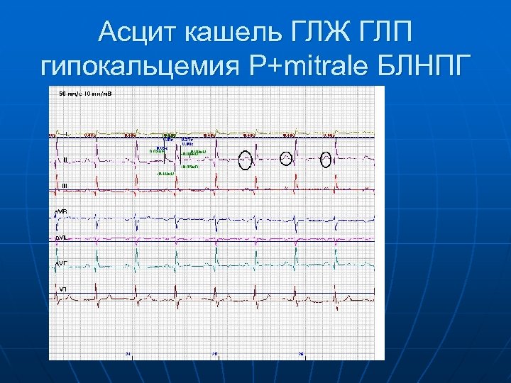 Асцит кашель ГЛЖ ГЛП гипокальцемия P+mitrale БЛНПГ 