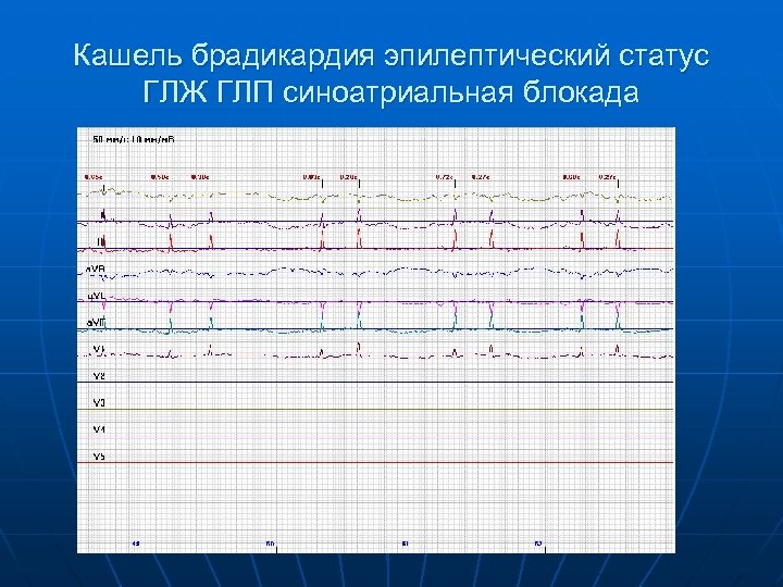 Кашель брадикардия эпилептический статус ГЛЖ ГЛП синоатриальная блокада 