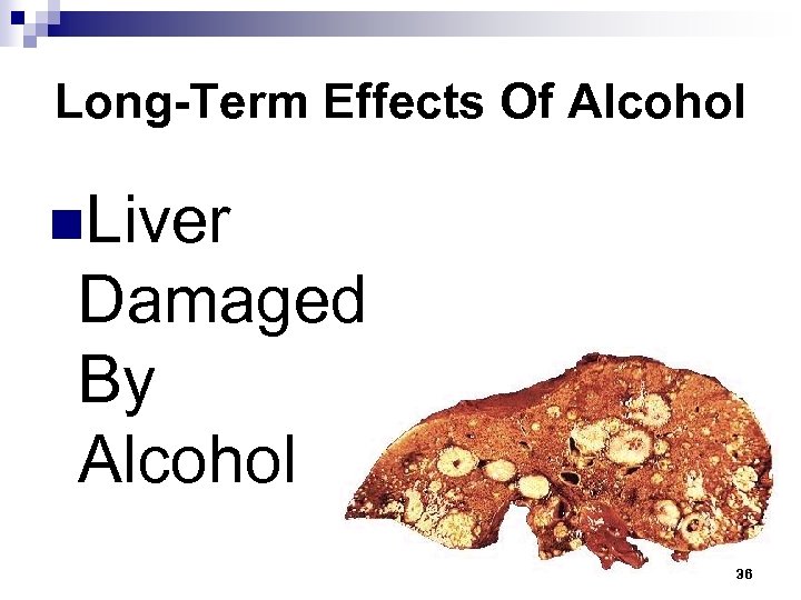 Long-Term Effects Of Alcohol n. Liver Damaged By Alcohol 36 