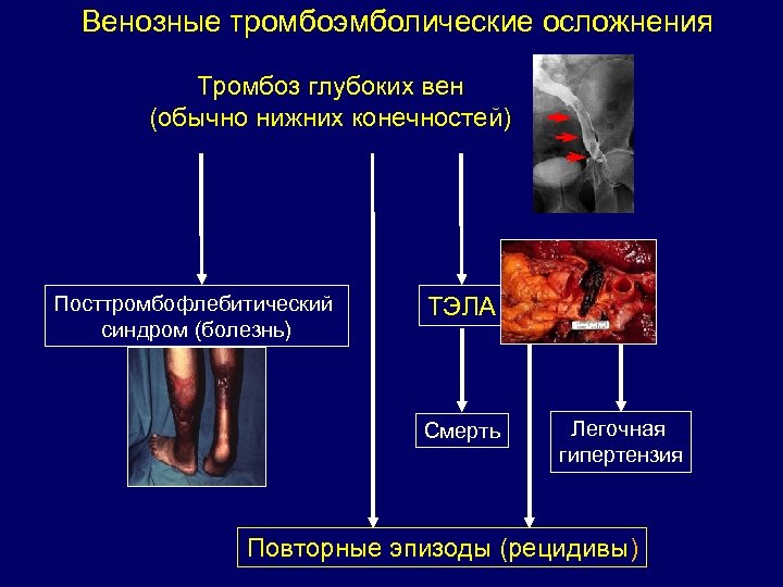 Тромбоз глубоких вен голени фото