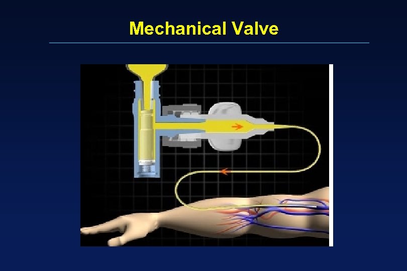 Mechanical Valve 