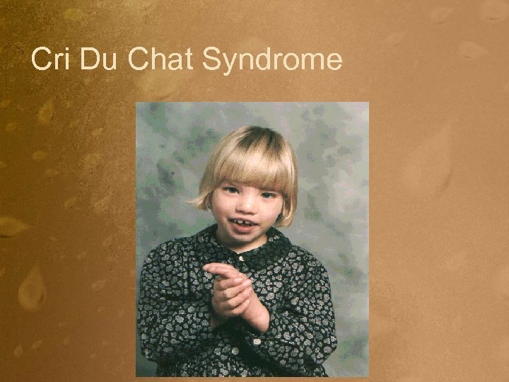 Cri Du Chat Syndrome 