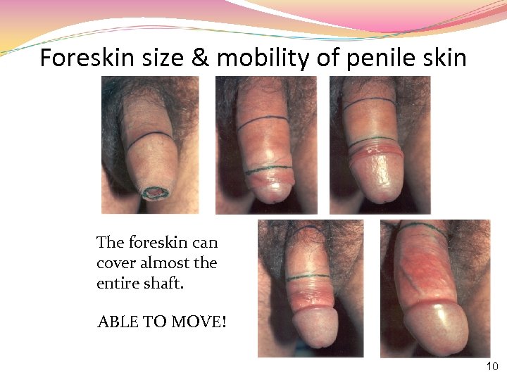 Foreskin size & mobility of penile skin The foreskin can cover almost the entire