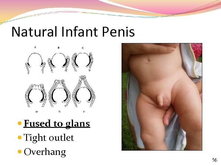 Natural Infant Penis Fused to glans Tight outlet Overhang 16 