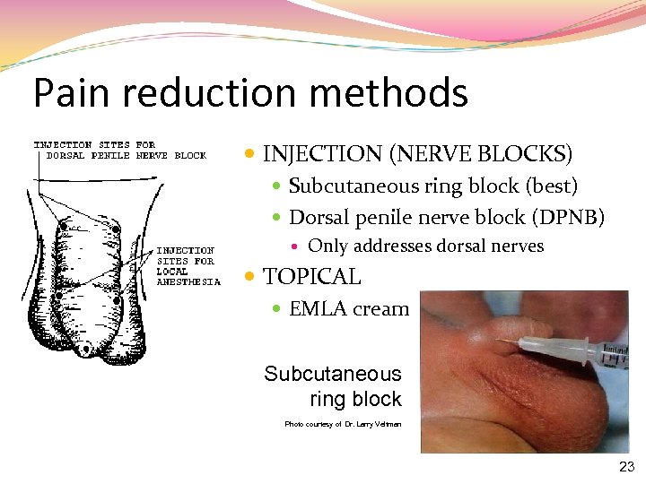 Pain reduction methods INJECTION (NERVE BLOCKS) Subcutaneous ring block (best) Dorsal penile nerve block