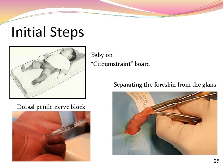 Initial Steps Baby on “Circumstraint” board Separating the foreskin from the glans Dorsal penile